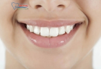 NHA KHOA BẢO TỒN - RĂNG KHỂNH LÀ GÌ?