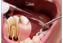 NHA KHOA BẢO TỒN - LẤY CHỈ MÁU RĂNG CÓ ĐAU KHÔNG?