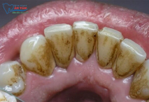 NHA KHOA BẢO TỒN - RĂNG ĐEN Ở MẶT TRONG DO ĐÂU?