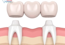 NHA KHOA BẢO TỒN - NHƯỢC ĐIỂM CỦA CẦU RĂNG SỨ LÀ GÌ?