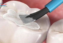 NHA KHOA BẢO TỒN - TRÁM RĂNG TẠM THỜI ĐỂ LÀM GÌ?