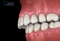 NHA KHOA BẢO TỒN - HÔ HÀM TRÊN VÀ BIỆN PHÁP KHẮC PHỤC HIỆU QUẢ