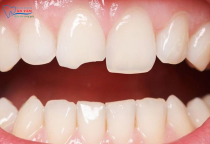 NHA KHOA BẢO TỒN - TRÁM RĂNG CỬA BỊ MẺ CÓ ĐAU KHÔNG?