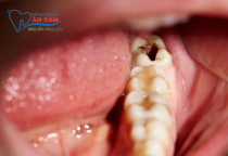 NHA KHOA BẢO TỒN - RĂNG SỐ 8 BỊ SÂU VỠ CÓ NGUY HIỂM KHÔNG?