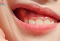 NHA KHOA BẢO TỒN - CÁCH NHẬN BIẾT VIÊM NHA CHU Ở TRẺ EM