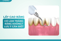 NHA KHOA BẢO TỒN - LẤY CAO RĂNG CÓ LÀM TRẮNG RĂNG KHÔNG?