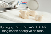 NHA KHOA BẢO TỒN - NHỮNG CÁCH CẦM MÁU SAU KHI NHỔ RĂNG HIỆU QUẢ