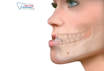 NHA KHOA BẢO TỒN - SAI KHỚP CẮN LOẠI 3 LÀ GÌ? CÁCH ĐIỀU TRỊ NHƯ THẾ NÀO?