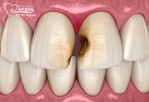 NHA KHOA BẢO TỒN - SÂU RĂNG CỬA NÊN LÀM GÌ?