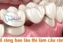 NHA KHOA BẢO TỒN - NHỔ RĂNG BAO LÂU THÌ LÀM CẦU RĂNG SỨ?