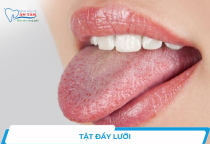 NHA KHOA BẢO TỒN - HẬU QUẢ CỦA TẬT ĐẨY LƯỠI