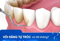 NHA KHOA BẢO TỒN - VÔI RĂNG TỰ TRÓC ĐƯỢC KHÔNG?