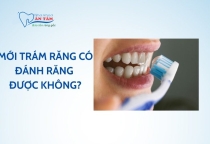 NHA KHOA BẢO TỒN - SAU KHI TRÁM RĂNG XONG CÓ ĐÁNH RĂNG ĐƯỢC KHÔNG?