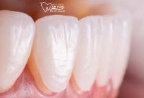 NHA KHOA BẢO TỒN - DÁN SỨ VENEER KHÔNG MÀI RĂNG LÀ GÌ?