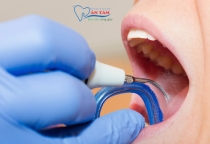 NHA KHOA BẢO TỒN - CẠO VÔI RĂNG CÓ BỊ Ê BUỐT KHÔNG?