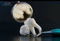 NHA KHOA BẢO TỒN - NHỔ RĂNG KHÔN BAO LÂU THÌ LÀNH?