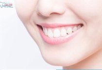 NHA KHOA BẢO TỒN - NHỮNG CẢM GIÁC SAU KHI BỌC RĂNG SỨ THƯỜNG GẶP NHẤT