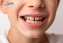 NHA KHOA BẢO TỒN - KHÔNG CÓ MẦM RĂNG VĨNH VIỄN CÓ SAO KHÔNG?
