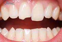 NHA KHOA BẢO TỒN - RĂNG BỊ GÃY CÓ TRÁM ĐƯỢC KHÔNG?