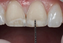 NHA KHOA BẢO TỒN - CÓ NÊN MÀI RĂNG CỬA KHÔNG?