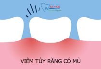 NHA KHOA BẢO TỒN - VIÊM TỦY RĂNG CÓ MỦ CÓ TỰ KHỎI KHÔNG?