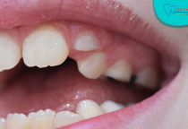 NHA KHOA BẢO TỒN - NGUYÊN NHÂN BỊ MỌC RĂNG THỪA