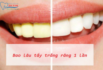 NHA KHOA BẢO TỒN - NÊN TẨY TRẮNG BAO LÂU MỘT LẦN