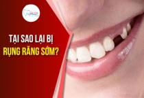 NHA KHOA BẢO TỒN - NGUYÊN NHÂN RỤNG RĂNG SỚM VÀ NHỮNG TÁC HẠI ĐÁNG SỢ