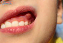 NHA KHOA BẢO TỒN - ÁP XE RĂNG VÀ NHỮNG ĐIỀU CẦN BIẾT