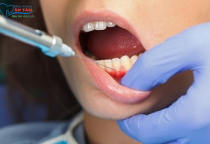 NHA KHOA BẢO TỒN - THUỐC TÊ TRONG NHA KHOA LÀ GÌ?