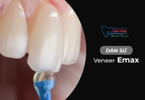 NHA KHOA BẢO TỒN - DÁN VENEER RĂNG THƯA CÓ BỀN KHÔNG?
