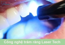 NHA KHOA BẢO TỒN - CÔNG NGHỆ TRÁM RĂNG LASER TECH