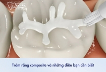 NHA KHOA BẢO TỒN - NHỮNG ĐIỀU CẦN BIẾT VỀ TRÁM RĂNG COMPOSITE
