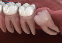 NHA KHOA BẢO TỒN - LỢI ĐANG SƯNG CÓ NHỔ RĂNG KHÔN ĐƯỢC KHÔNG?