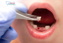 NHA KHOA BẢO TỒN - KHI NÀO NÊN NHỔ RĂNG SỮA CHO TRẺ EM