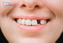 NHA KHOA BẢO TỒN - MẤT RĂNG: HẬU QUẢ VÀ CÁCH KHẮC PHỤC