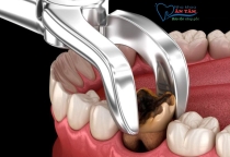 NHA KHOA BẢO TỒN - NHỔ RĂNG CẤM CÓ BỊ HÓP MÁ KHÔNG?