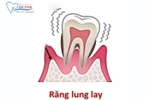 NHA KHOA BẢO TỒN - RĂNG BỊ LUNG LAY DO ĐÂU?