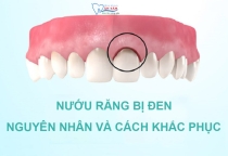 NHA KHOA BẢO TỒN - ĐIỀU TRỊ NƯỚU BỊ THÂM ĐEN