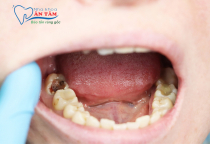 NHA KHOA BẢO TỒN - TRẺ EM BỊ SÂU RĂNG HÀM CÓ MỌC LẠI KHÔNG?