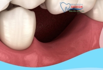 NHA KHOA BẢO TỒN - MẤT RĂNG BAO LÂU THÌ BỊ TIÊU XƯƠNG HÀM?