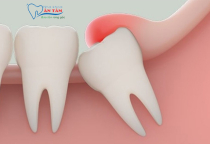 NHA KHOA BẢO TỒN - CÓ NÊN NHỔ RĂNG KHÔN KHÔNG