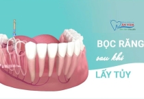 NHA KHOA BẢO TỒN - CÓ NÊN BỌC RĂNG SỨ SAU KHI LẤY TỦY?