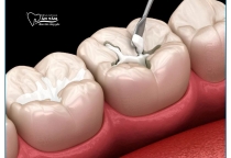 NHA KHOA BẢO TỒN - TÁC HẠI CỦA VIỆC TRÁM RĂNG SAI KỸ THUẬT