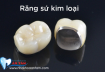 CÓ NÊN BỌC RĂNG SỨ KIM LOẠI KHÔNG? CÓ NÊN BỌC RĂNG SỨ KIM LOẠI KHÔNG?
