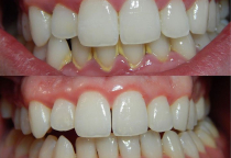 BAO LÂU NÊN CẠO VÔI RĂNG ĐỊNH KÌ 1 LẦN? BAO LÂU NÊN CẠO VÔI RĂNG ĐỊNH KÌ 1 LẦN?