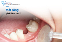 MẤT CHÂN RĂNG PHẢI LÀM NHƯ THẾ NÀO? MẤT CHÂN RĂNG PHẢI LÀM NHƯ THẾ NÀO?