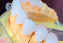 KHI NÀO THÌ NÊN BỌC RĂNG SỨ THẨM MỸ KHI NÀO THÌ NÊN BỌC RĂNG SỨ THẨM MỸ