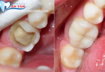 CÁCH KHẮC PHỤC RĂNG BỊ GÃY,BỂ,MẺ CÁCH KHẮC PHỤC RĂNG BỊ GÃY,BỂ,MẺ