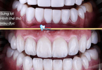 CÁCH NHẬN BIẾT RĂNG SỨ CHÍNH HÃNG VÀ RĂNG SỨ KÉM CHẤT LƯỢNG CÁCH NHẬN BIẾT RĂNG SỨ CHÍNH HÃNG VÀ RĂNG SỨ KÉM CHẤT LƯỢNG